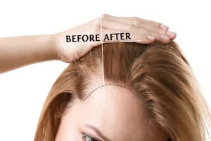 Donna perdita di capelli